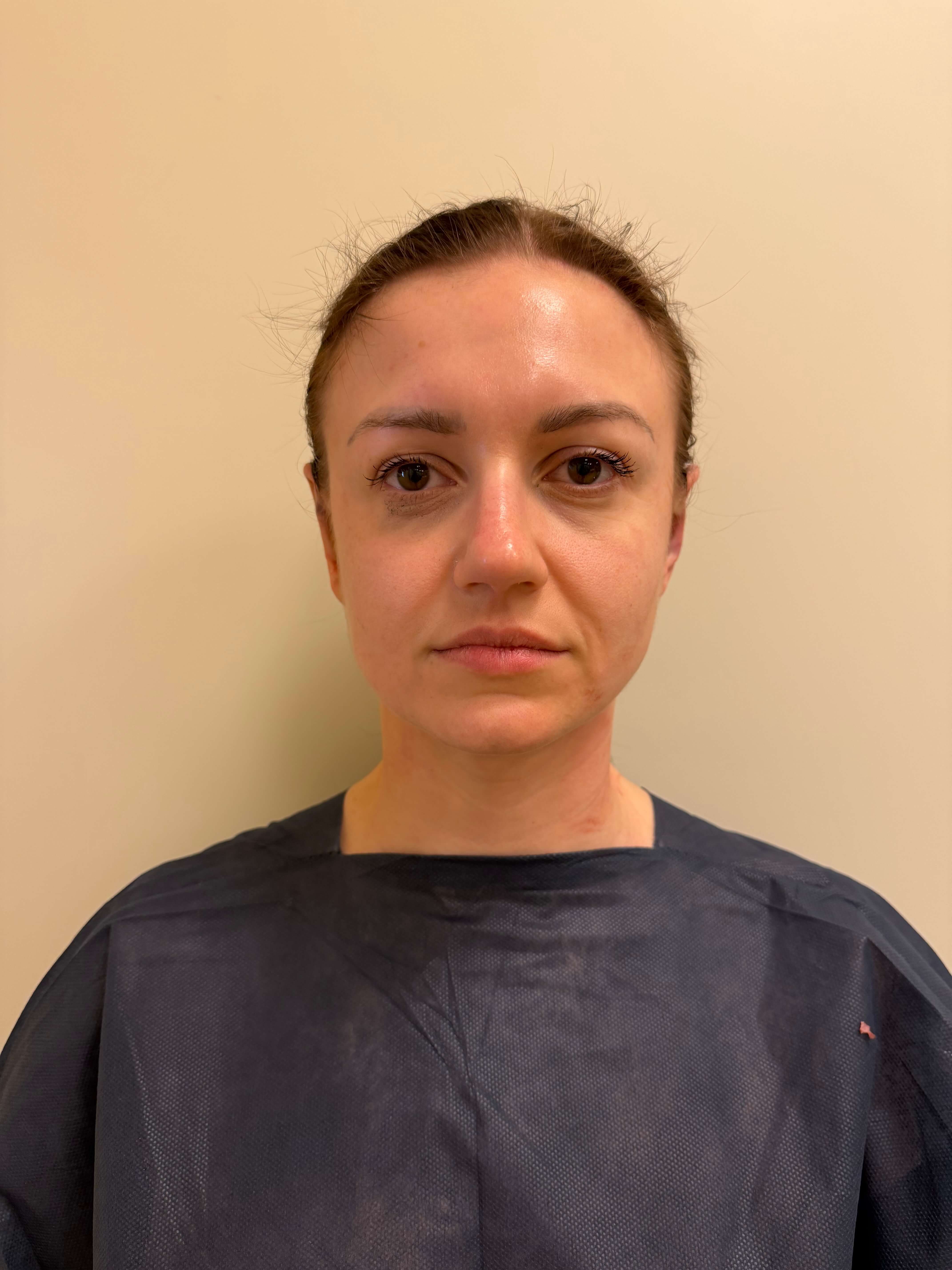 Po zabiegu – Otoplastyka