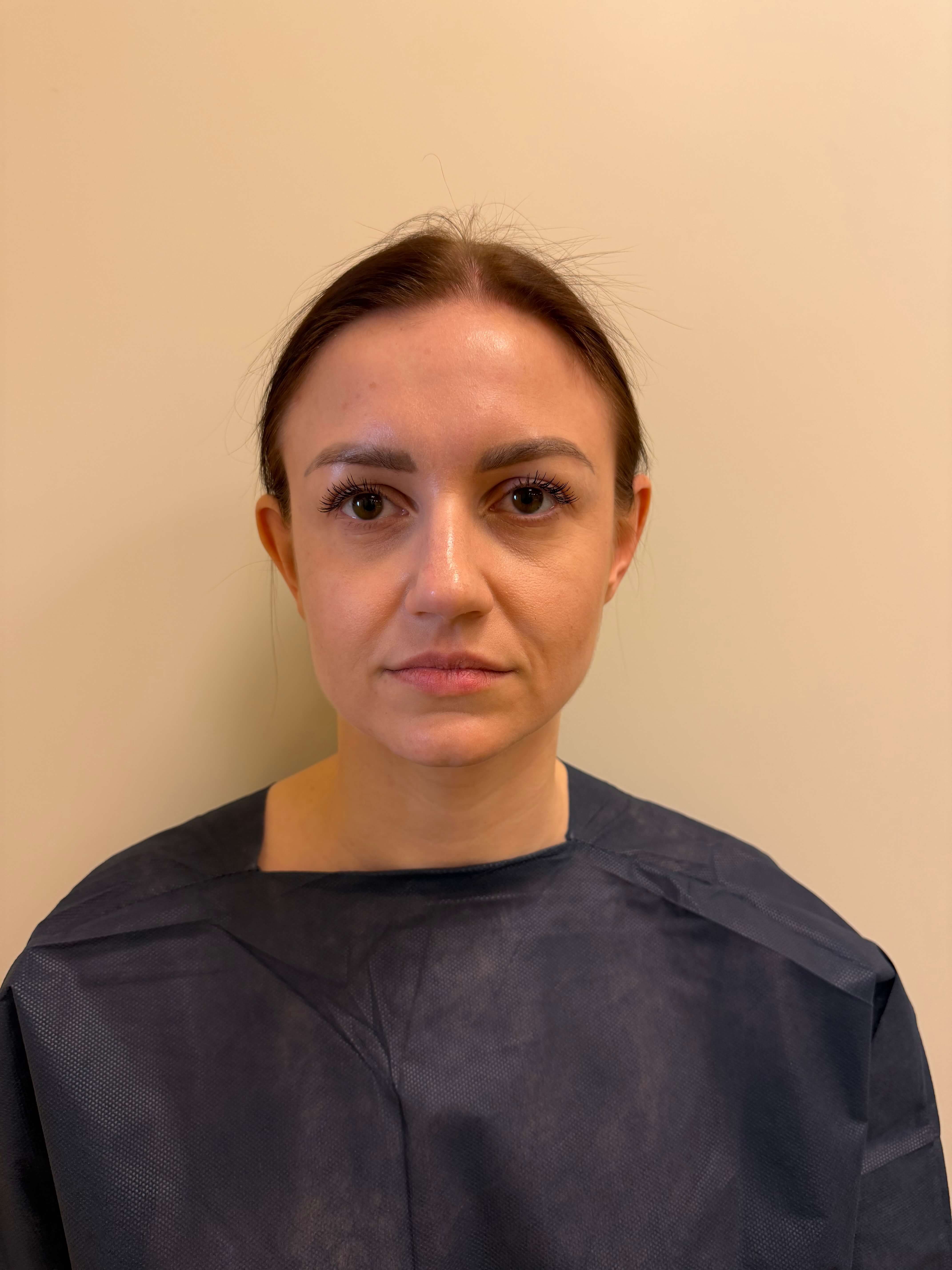 Przed zabiegiem – Otoplastyka